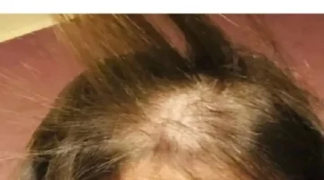 فشل جلسة تجميل.. فنانة مصرية تفقد شعرها بالكامل